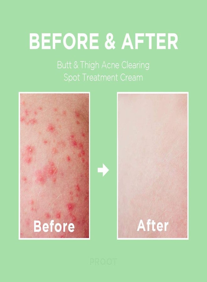 Proot Butt Acne Treatment Cream in Tube Type | Travel Friendly | Clears Acne, Ingrown Hairs, Zits, Razor Bumps, Blackheads and Dark Spots for the Butt, Thigh and Other Sensitive Area | Prevents Future Breakouts - Image 2